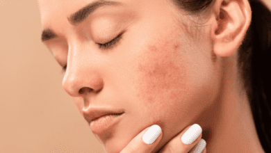 Photo of 5 Amazing Ways to Get Rid of Acne Scars Before Your Wedding