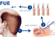 Photo of How to Identify If the Hair Loss Is Stress-Related?