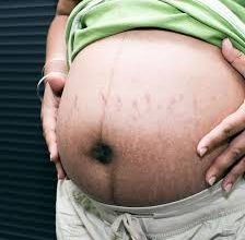 Photo of The Secret to Stretch Mark Prevention