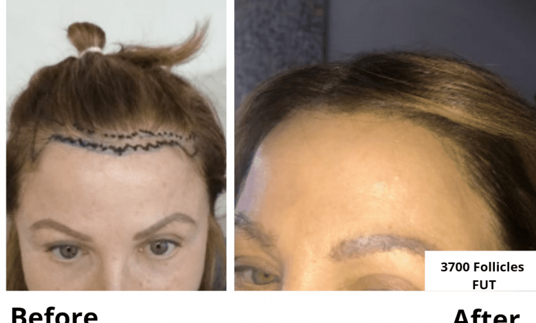 hair fall treatment