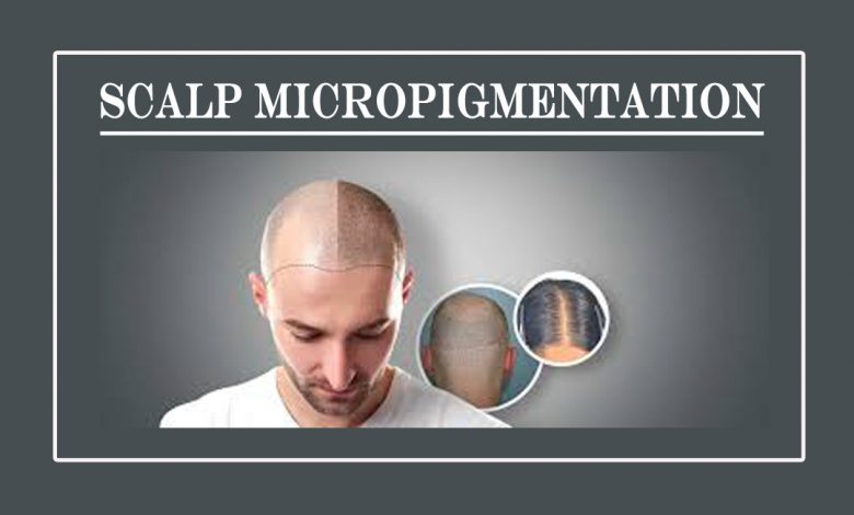 scalp micropigmentation- How is Scalp Micropigmentation treatment Beneficial for hair loss?