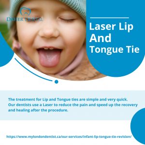 lip and tongue tie