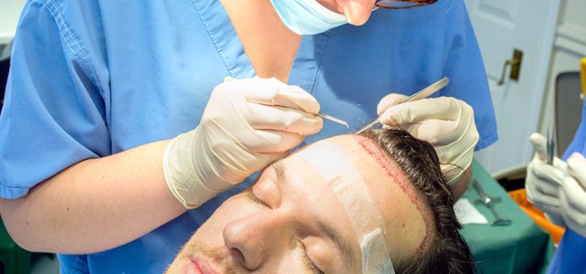 hair transplant