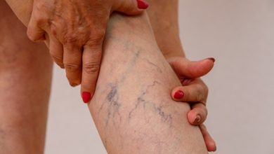 Photo of What Are My Options To Treat Spider Veins?