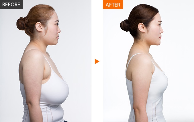 Breast Reduction Surgery