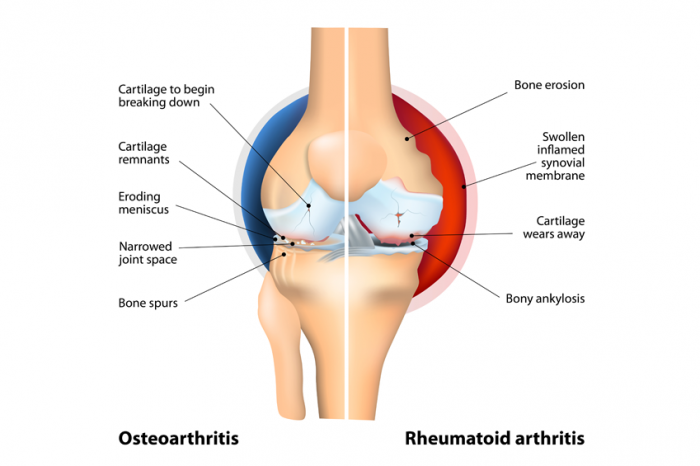 arthritis