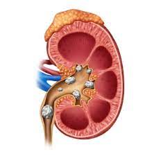 kidney stone and its symptoms