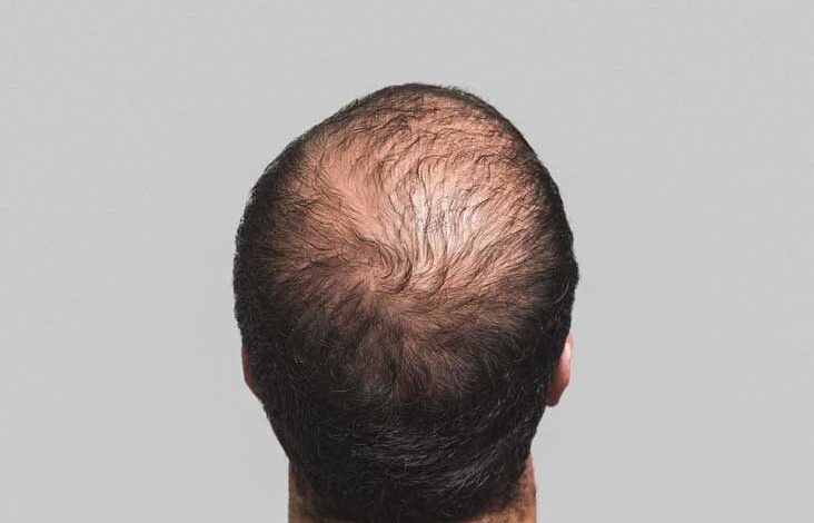 Hair Transplantation