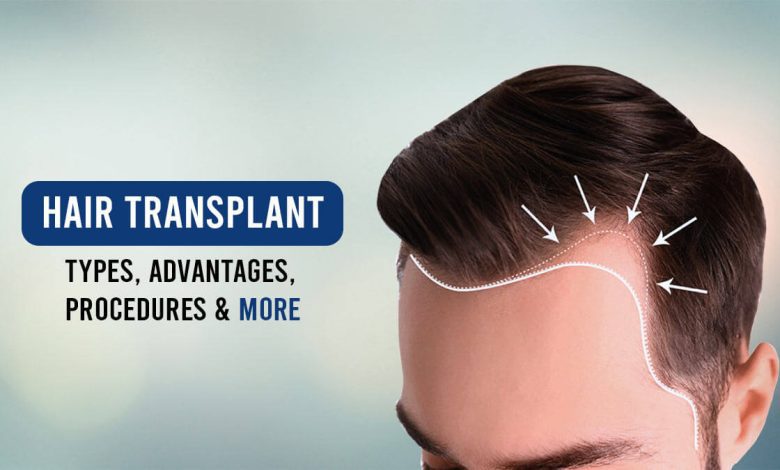 Hair transplant in punjab