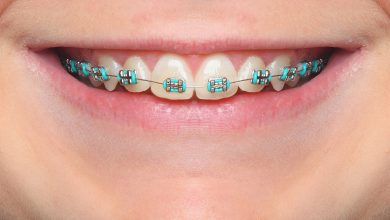 Photo of What are the best colors for braces?