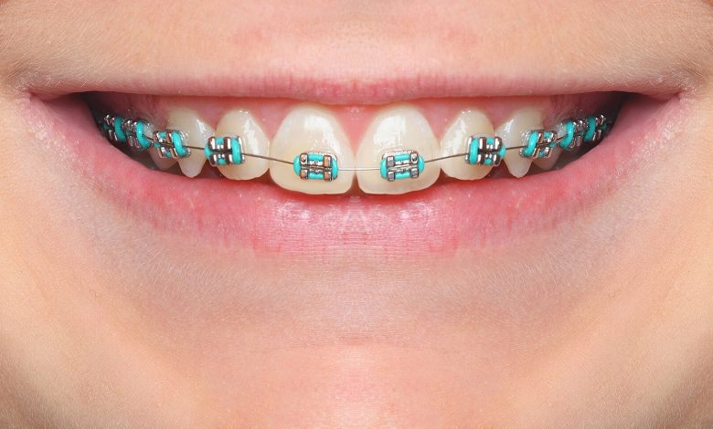 dentist for braces near me