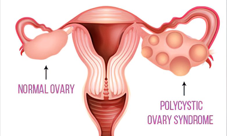 IVF treatment