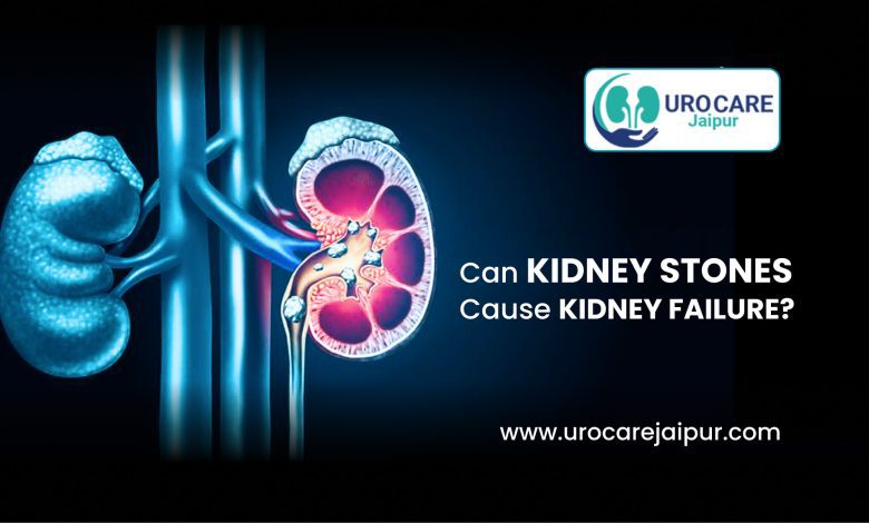 Can Kidney Stones causes kidney failure-Dr Lokesh Sharma-UrocareJaipur