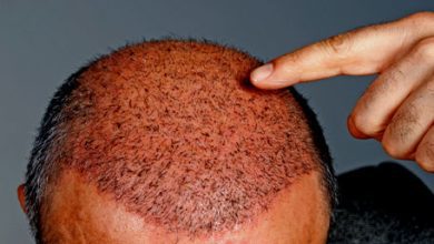 Photo of What are the primary factors that cause hair fall or baldness in people?