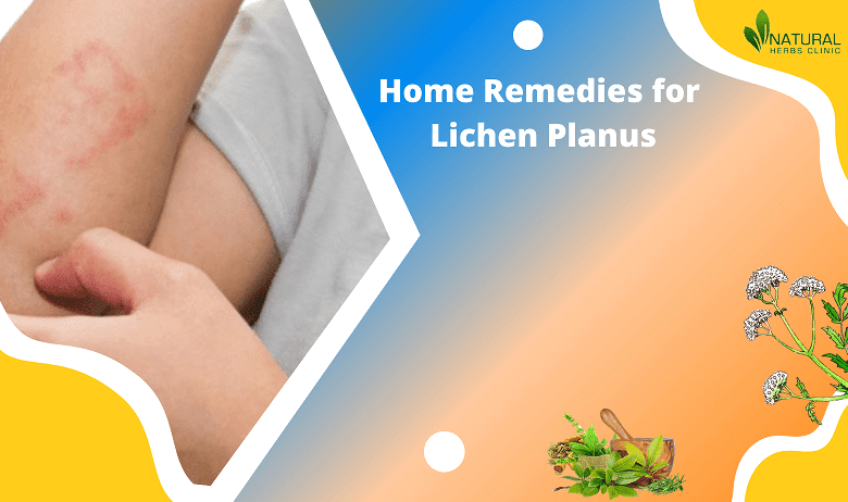 Home Remedies for Lichen Planus