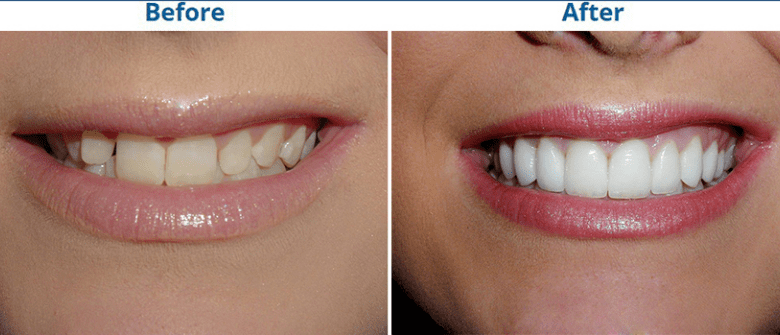 porcelain teeth veneers