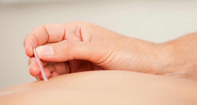 Everything you need to know about acupuncture therapy