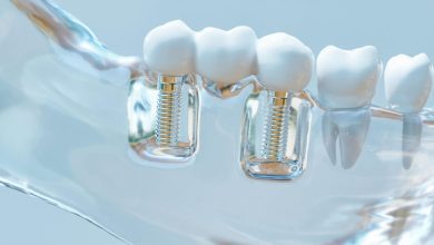 Photo of Cosmetic Dental Implants for Gorgeous Smiles: Getting the Facts Straight