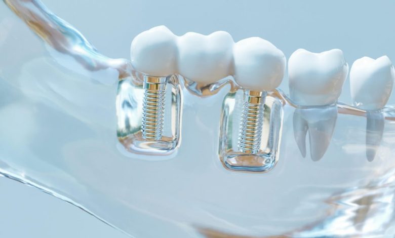 cosmetic dental implants