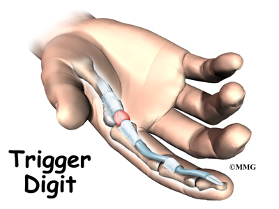 trigger finger treatment Singapore