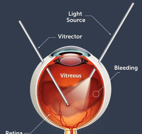 retina surgery