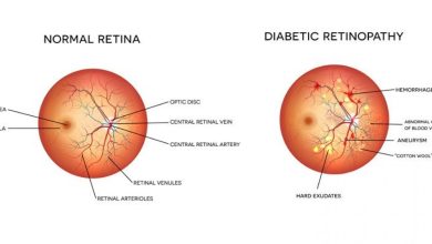 Photo of Diabetic retinopathy – Symptoms and causes