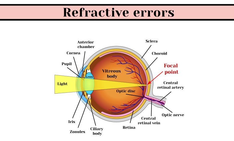 types of refractive error