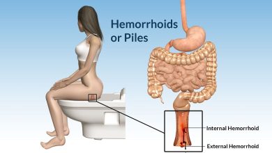 Photo of What is Hemorrhoids?