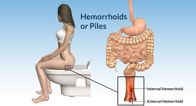 What is Hemorrhoids