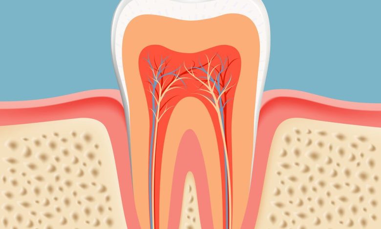 Root Canal