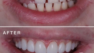 Photo of The Complete Guide To Dental Bonding Cost And Why It Is The Best Option For You
