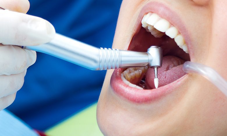 root canal treatment in Toronto