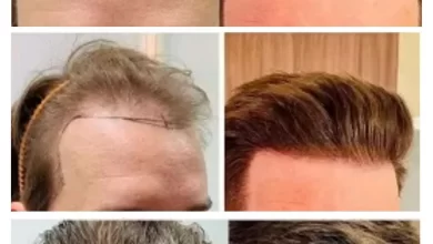 Photo of 15 Questions to Ask Before Committing to a Hair Transplant