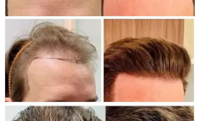 hair transplant questions