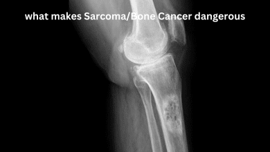 Photo of What Makes Sarcoma/Bone Cancer Dangerous