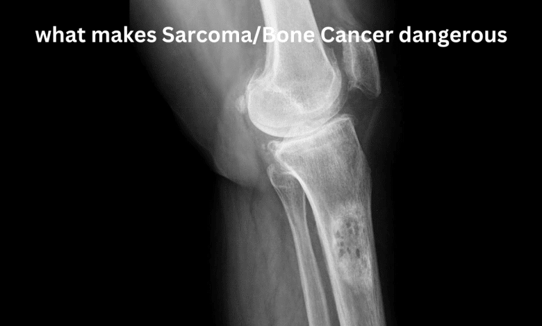 Sarcoma