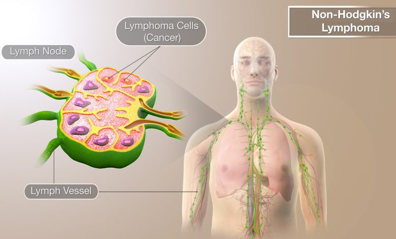 Types of Non-Hodgkin Lymphoma