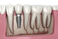 Photo of Dental Implants In London Ontario: A Step-By-Step Guide