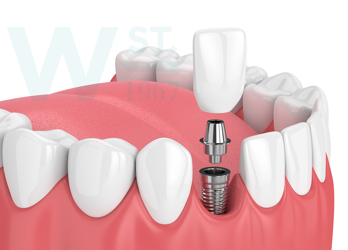 Dental implants London Ontario