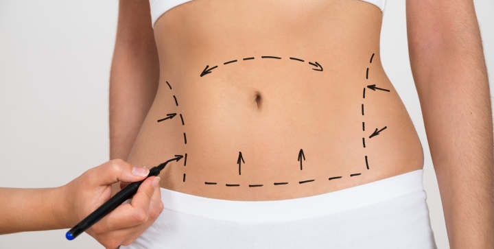 Tummy Tuck surgery in Dubai